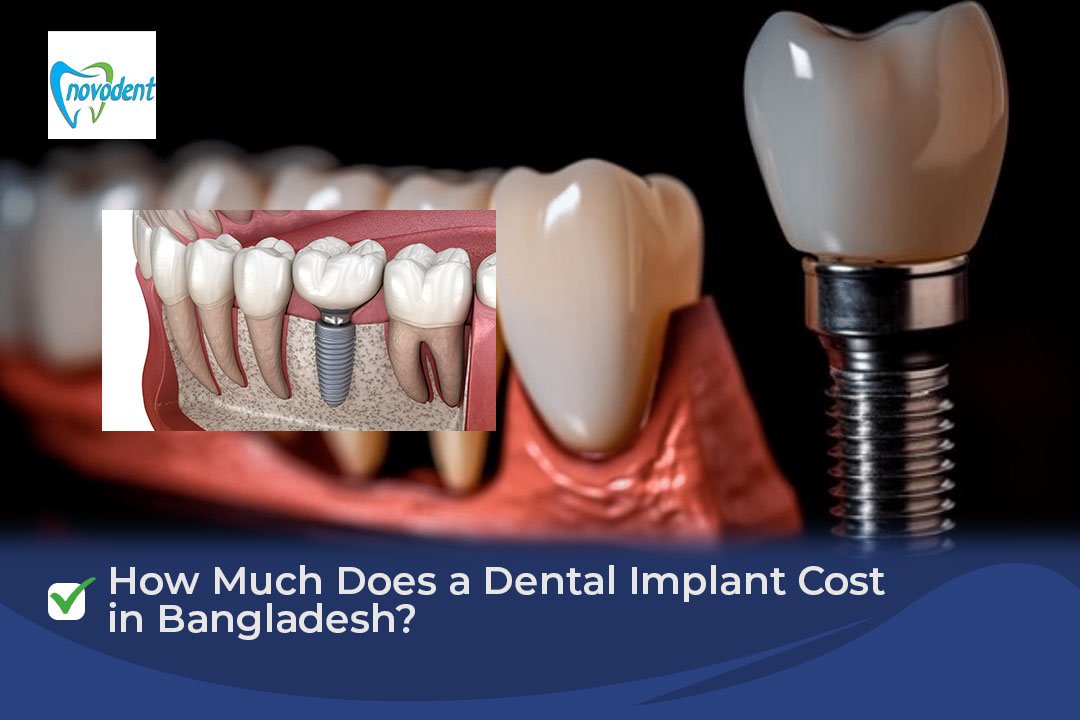 Dental Implant Cost in Bangladesh?