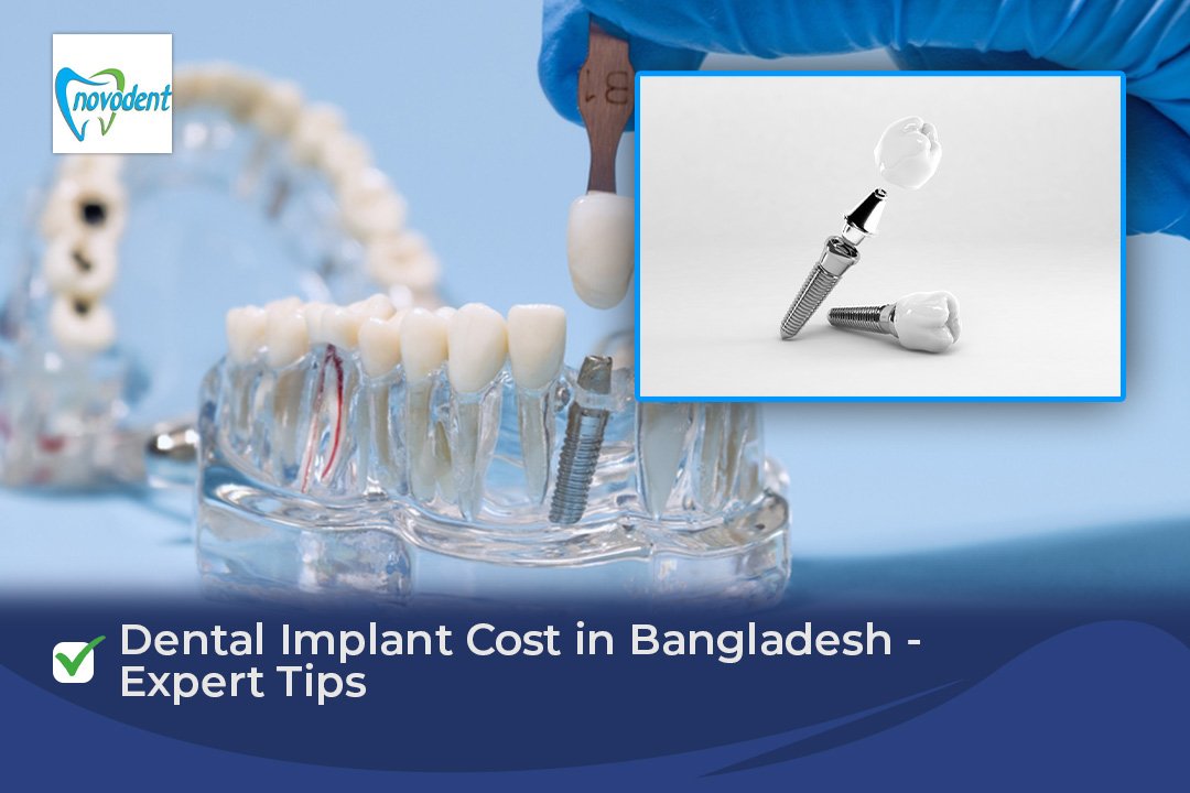 Dental Implant Cost in Bangladesh - Expert Tips