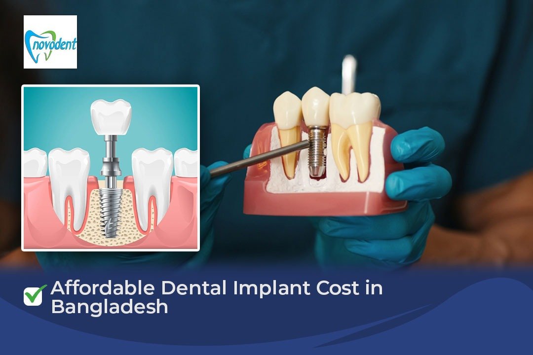 Affordable Dental Implant Cost in Bangladesh Affordable Dental Implant Cost in Bangladesh