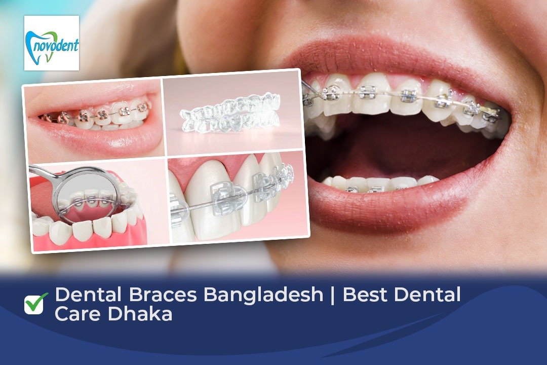Dental Braces Bangladesh | Best Dental Care Dhaka Dental Braces Bangladesh | Best Dental Care Dhaka