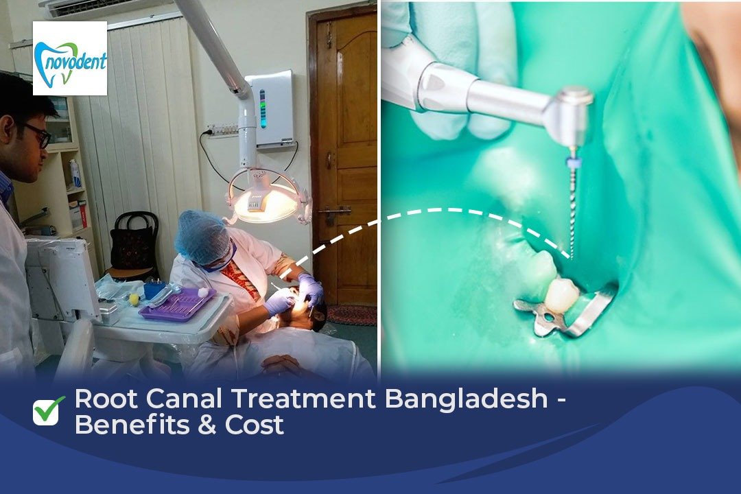Root Canal Treatment Bangladesh - Benefits & Cost