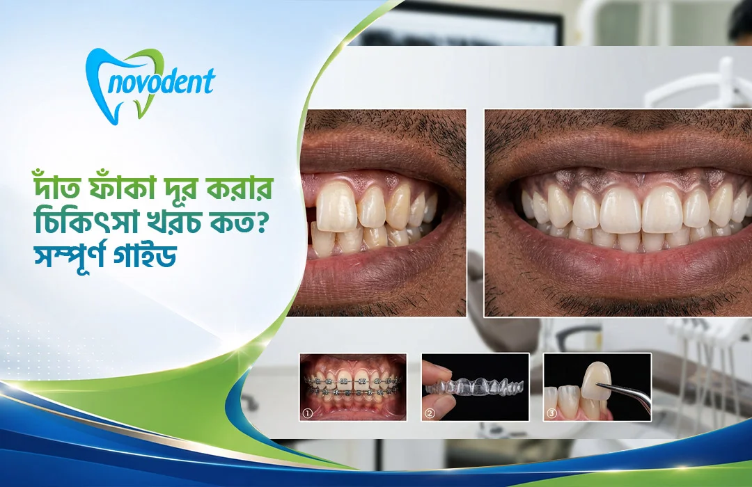 দাঁত ফাঁকা দূর করার চিকিৎসা খরচ কত? সম্পূর্ণ গাইড